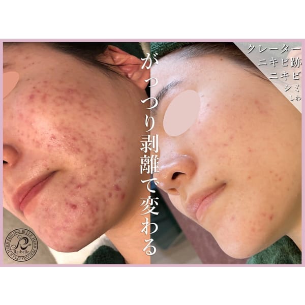 *がっつり剥離で最大効果*【剥離あり】ハーブピーリング《顔》¥14000(金券付)