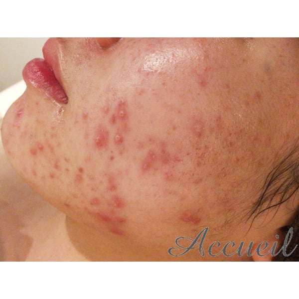 【結果重視の方☆】多発ニキビをとにかく抑えたい…大人の頑固なニキビ撃退コース◎