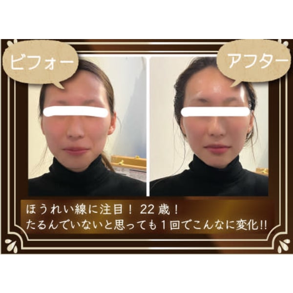 フェイスリフト　