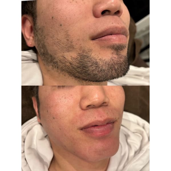 【初回】【地域低価格／メンズ】全身脱毛 （顔orVIO）