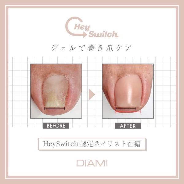 初回☆【大注目!韓国発ジェルで巻き爪ケア☆HeySwitch】両親指巻き爪ケア+ジェルコース