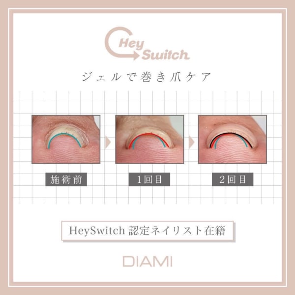 リピーター様☆【大注目!韓国発ジェルで巻き爪ケア☆HeySwitch】両親指巻き爪ケア+ジェルコース