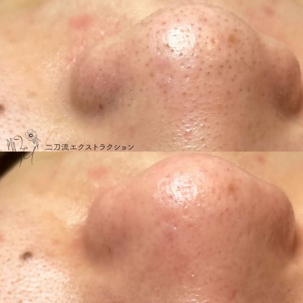 【いちご鼻改善！毛穴汚れスッキリ！】二刀流毛穴エクストラクション鼻眉間¥8800