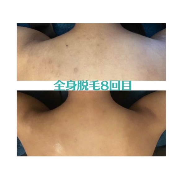 【夏クーポン】２機種で脱毛最短卒業★全身◆60分1回脱毛体験