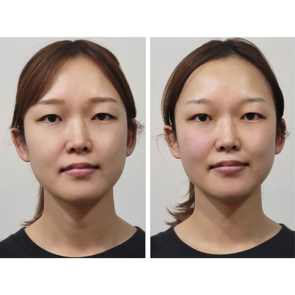 【ご新規】顔の悩みは小顔矯正がピッタリ ★オーダーメイド美容小顔矯正120分★