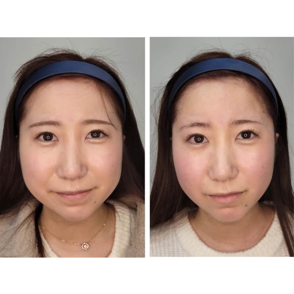 【ご新規】人気No.2／スッキリ小顔★小顔矯正＋デコルテリンパドレナージュ 150分★