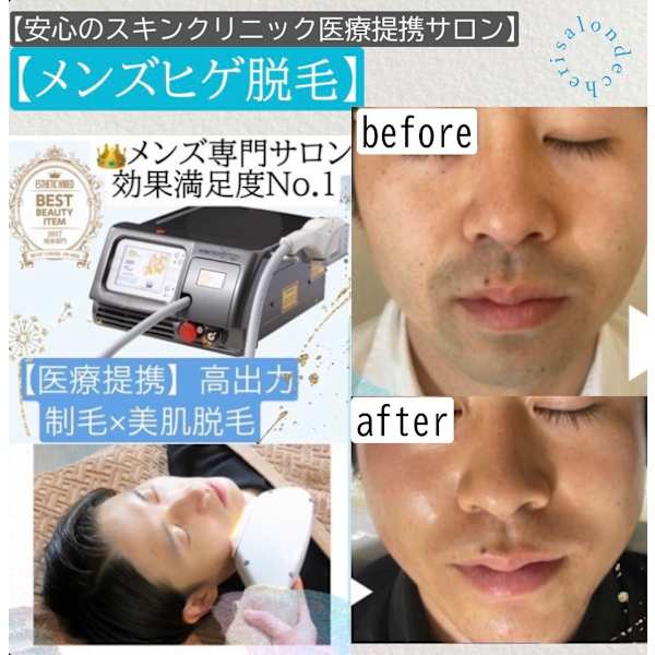 人気No.3【メンズ脱毛☆髭脱毛】高出力脱毛機で髭を撃退!IPLフェイシャルで美肌に☆
