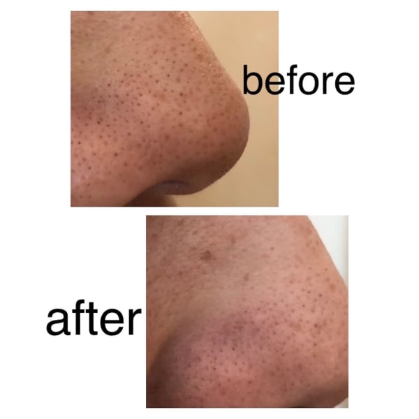 お顔脱毛＋いちご鼻撃退！毛穴吸引1回8,250円毛穴レス！コラーゲン生成