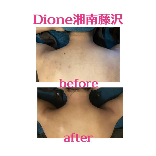 ☆キレイな背中〈脱毛×背中ニキビケア〉☆3300円