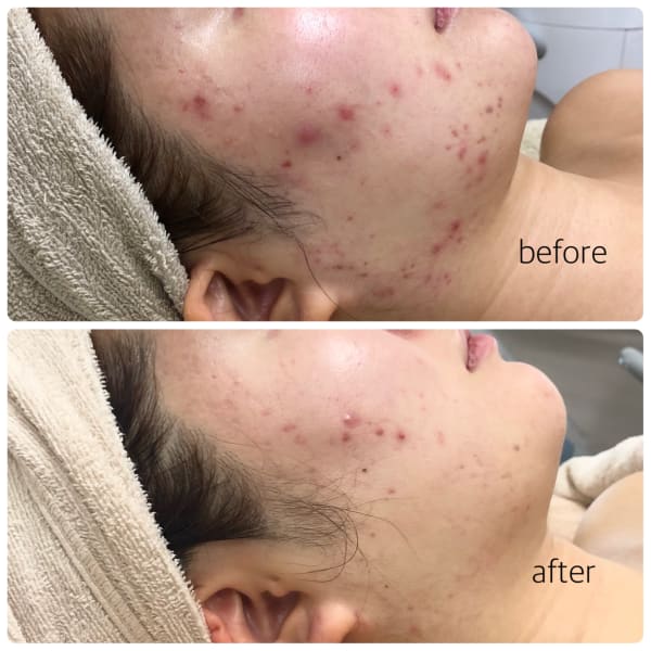 <人気No.3★シミ/しわ集中改善>毛穴徹底ケア+極エイジング+デコルテ 90分