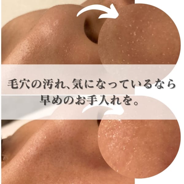 【くすみ&毛穴ケア】ピーリング光フェイシャル