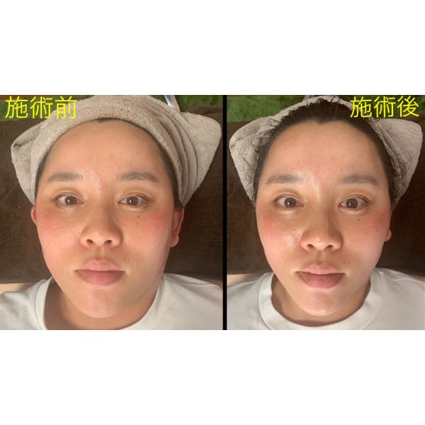 ★お顔のたるみ・くすみ・ほうれい線を撃退★【小顔矯正＋ドライヘッド】50分5,750円