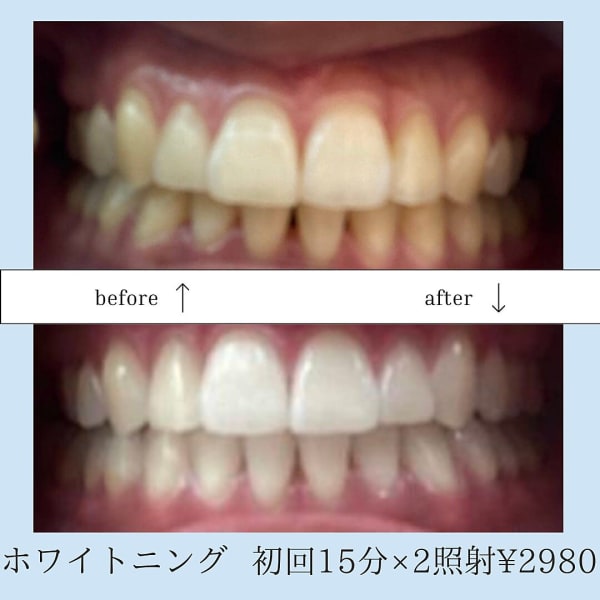【自然な白さへ】セルフホワイトニング30分照射 2980円！