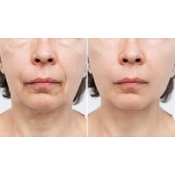 医療提携『小顔美顔プレミアム』若々しく美しく！リフトアップ！