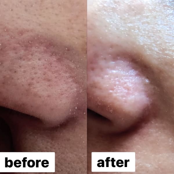 【学割プラン】ニキビにお悩みの学生様限定♪ツヤ肌美人・毛穴スッキリコース