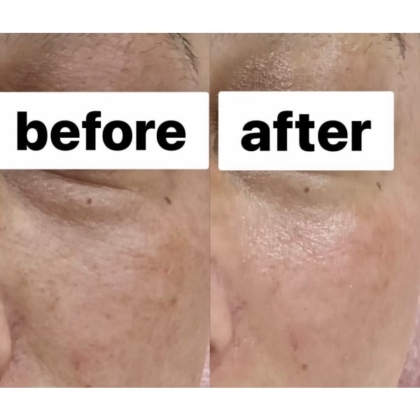 【新規限定】気になるほうれい線、マリオネットライン《しわ・たるみに》リフトアップエイジングケアコース