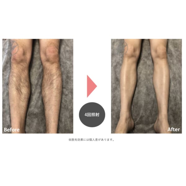 こんなに抜ける？！と驚かれる抜群の脱毛力★★脚全体脱毛でつるつる美脚！