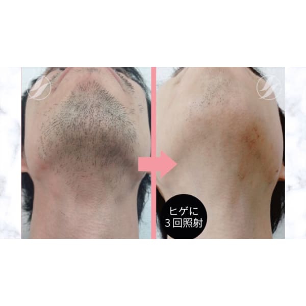 【メンズ脱毛】首から頬までしっかり全体♪ヒゲ脱毛