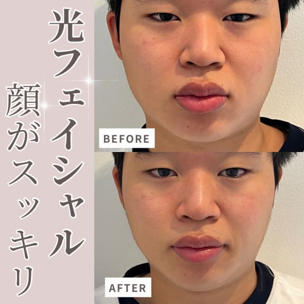 【おススメ！】☆光フェイシャル☆小顔すっきり♪ ￥4,800※女性可