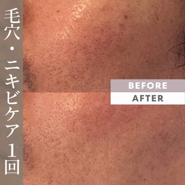 毛穴・肌トラブルケア乳酸ピーリングコース￥4,800 　※女性可