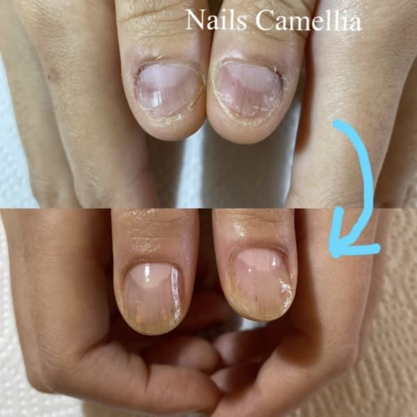 深爪・噛み爪など…爪を上手く伸ばせない方のお悩み爪のケア