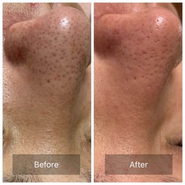 韓国式3D毛穴洗浄＋毛穴引き締め美容液　2回セット