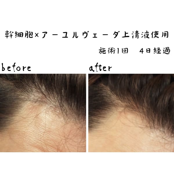 幹細胞エクソソーム×アーユルヴェーダの頭皮ケア【髪質改善・抜け毛予防】+ヘッドマッサージ30分