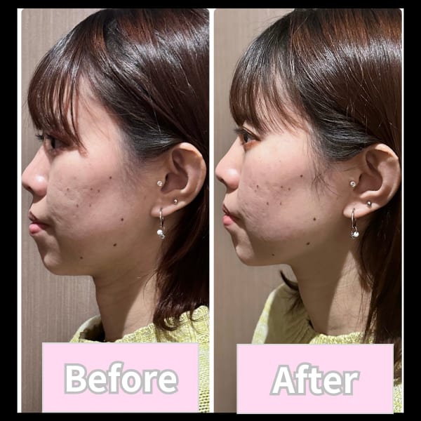 初めての方におすすめ！小顔効果抜群♪NAORU式★美容施術¥4400⚠伊藤限定
