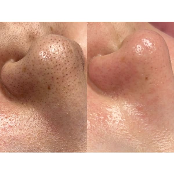 【SNSで話題！】【今1番人気◎】韓国式3D毛穴洗浄￥15,400→￥8,800【汚れを浮かせる！】