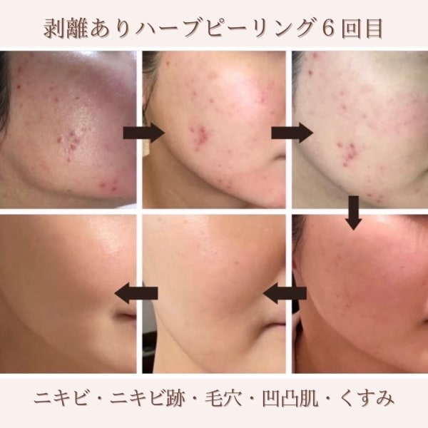 【極上美肌】ハードハーブピーリング・毛穴洗浄￥9,800