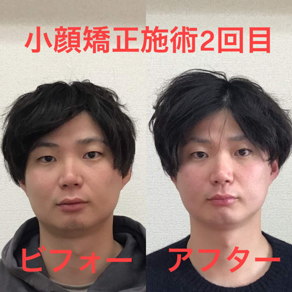 【初回お試し】リフトアップしてシャープにキュッと引き締めたい☆気持ち良いメンズ小顔矯正 約100分