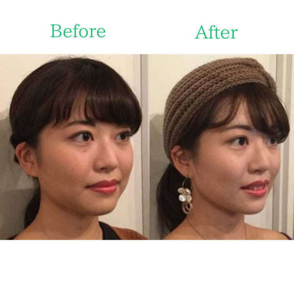 【美鼻／小顔】高さ／形／お顔の悩み全てOK！隆鼻＋輪郭・小顔矯正40分13200→9900