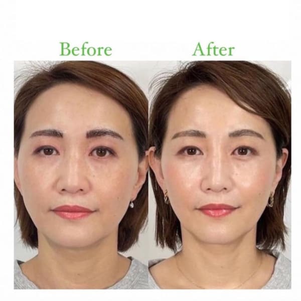 当店人気NO.1☆【美鼻／小顔】隆鼻＋リフトアップ＋輪郭・小顔矯正50分14300→9900