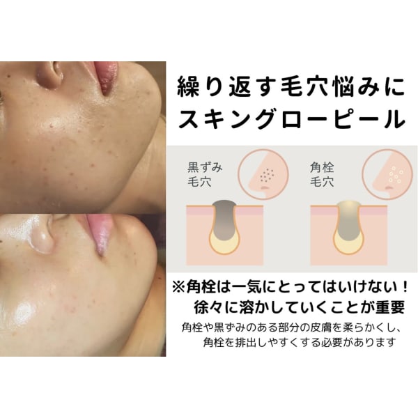 【黒ずみ・角栓悩みの方】皮脂・常在菌チェック付/スキングローピール¥9,900-