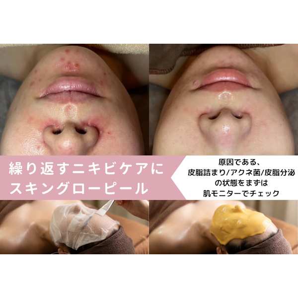 【跡・肌荒れケア】皮脂常在菌角層チェック付スキングローピール¥9,900-