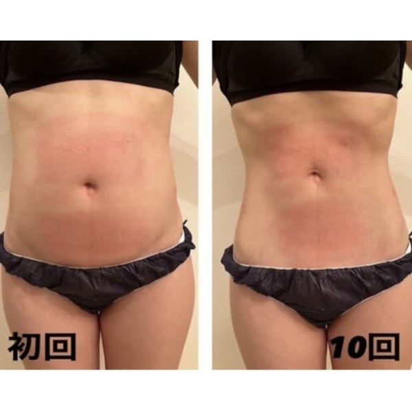 【20名様限定！】-12℃脂肪冷却！夏に向けて全身美BODY20カップ！初回限定78,000円