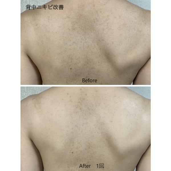 【背中肌荒れニキビ改善】クレンジング＆オイルマッサージ＆泡洗浄＆角質ケアor脱毛　約90分