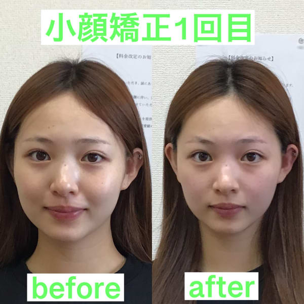 【初回お試し】３キロ痩せて見える☆エラやむくみが気なる方もキュッと小顔に☆痛気持ち良い小顔矯正コース
