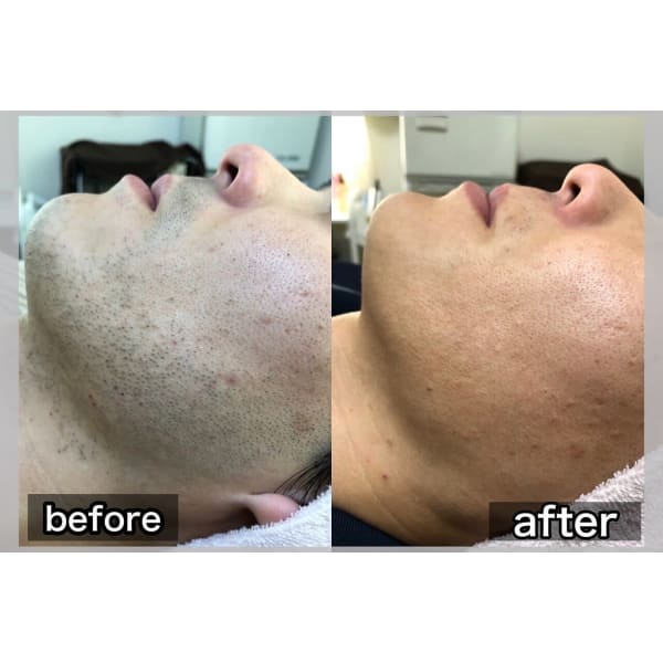 GOLDPLUS自慢の最新脱毛！初回限定で驚きの￥500！パック付き♪