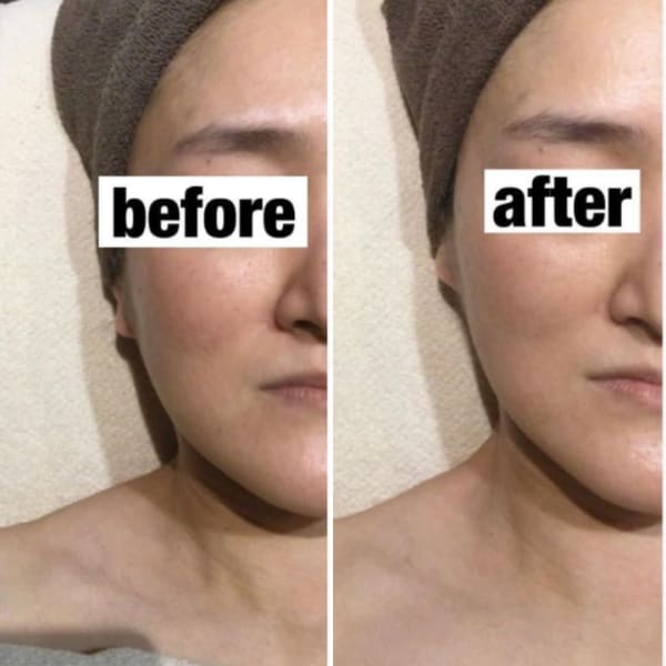 1日1名限定【毛穴・シミ・小顔など、肌質を根本改善】80分28600円→8800円