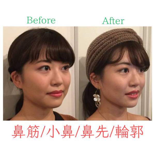 【お鼻の高さがほしい方】隆鼻+輪郭・小顔矯正 施術40分 所要時間90分目安
