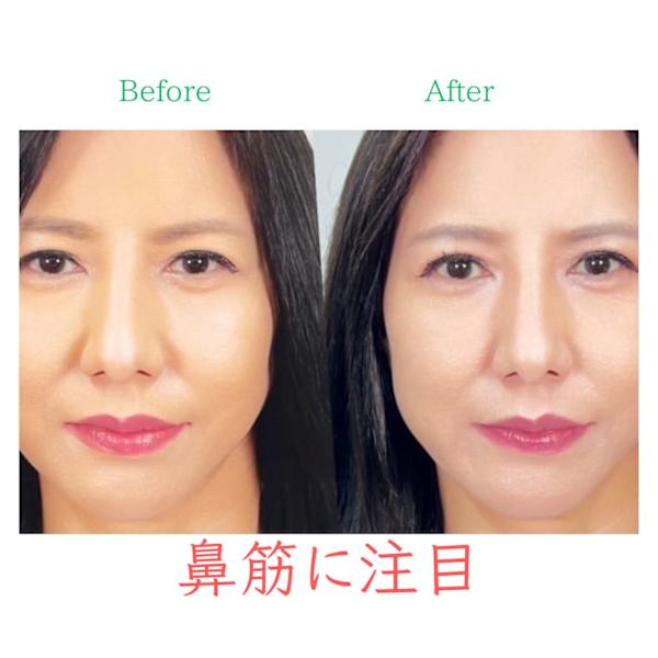 【鼻筋をハッキリさせたい方】隆鼻矯正+輪郭・小顔矯正 40分 所要時間90分目安