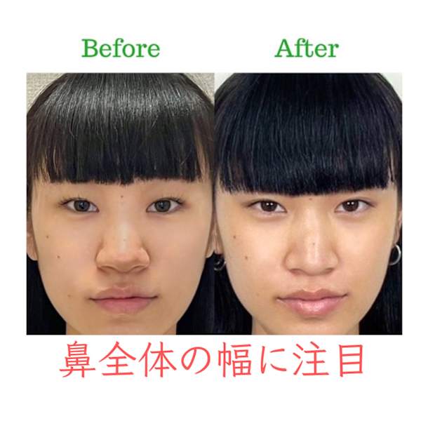 【鼻の形を細く小さくしたい方】隆鼻矯正+輪郭・小顔矯正40分 所要時間90分目安