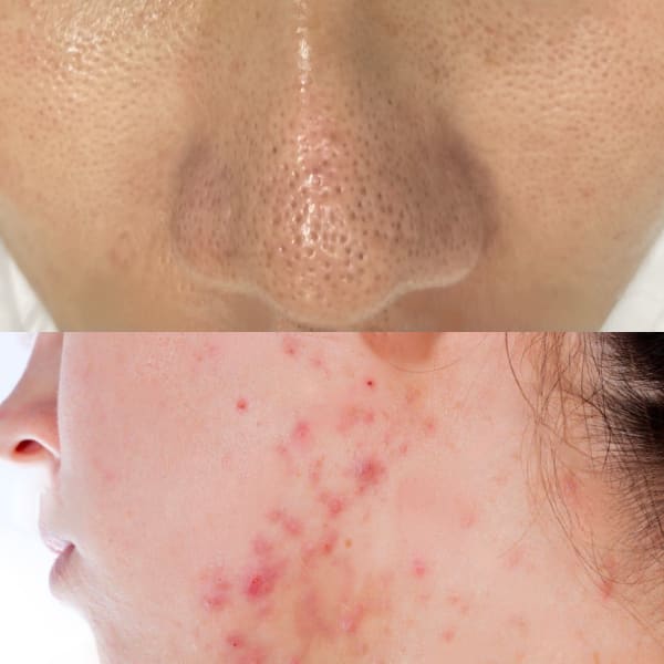 【メンズニキビケア/頑固な毛穴黒ずみ/テカリ肌解消】バクテリウムピール で自信のもてるモテ肌に♪