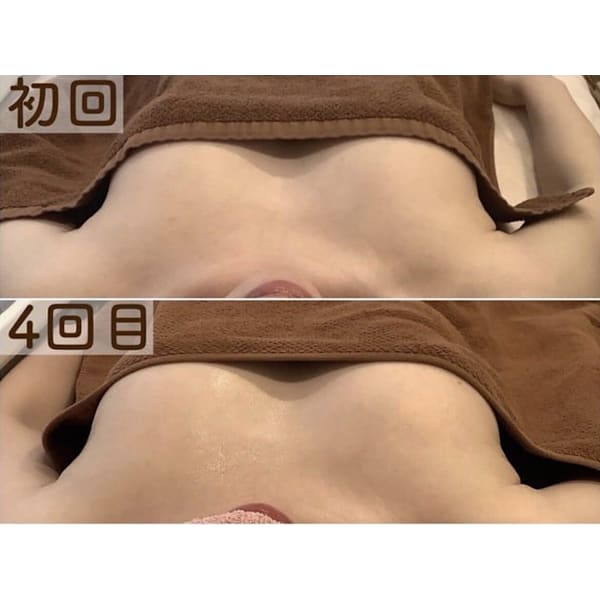 【クーパー靭帯修復バストケア】BBLバストアップ