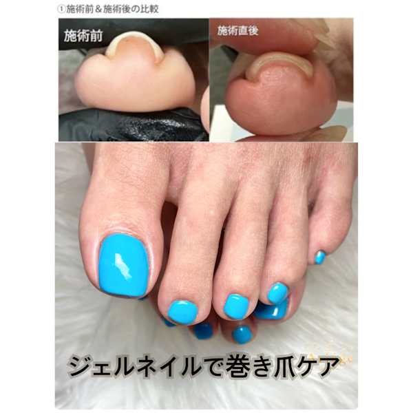 最新【巻き爪ケアジェル】親指1本巻き爪＋ワンカラー　※出血腫れ等無い方