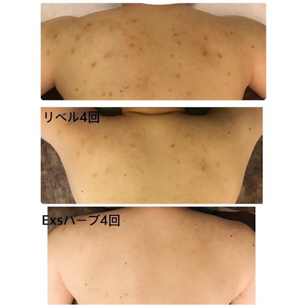 人気No.1セット！Exsハーブ【二の腕背上or背中全部】90分24000→¥14900