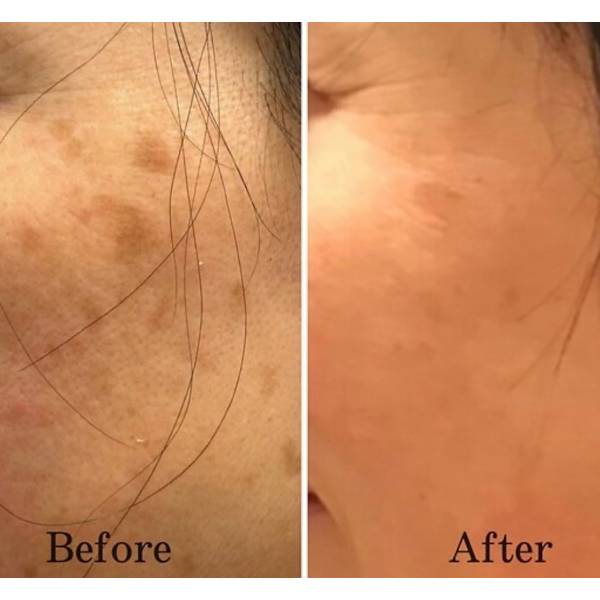 【目の下の斑点にも◎】全てのシミケアし放題