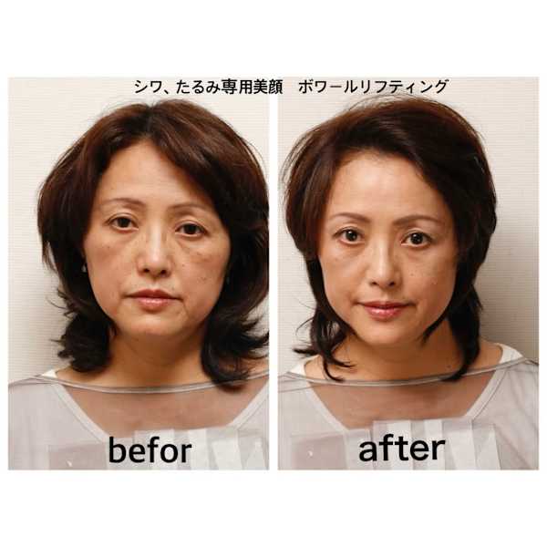 細胞エイジング!ボワールリフティング+エクソソーム導入16500円→8800円