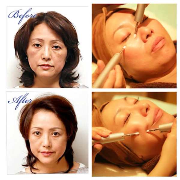 【保湿力UP】スーパーリフトアップボワールリフティング+プラセンタ導入 16500円→8800円